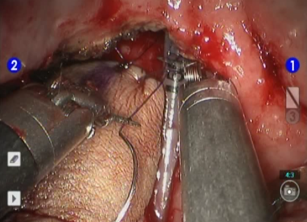 Figure 2. Inset of the flap into the oropharyngeal defect using the Da Vinci surgical system..png